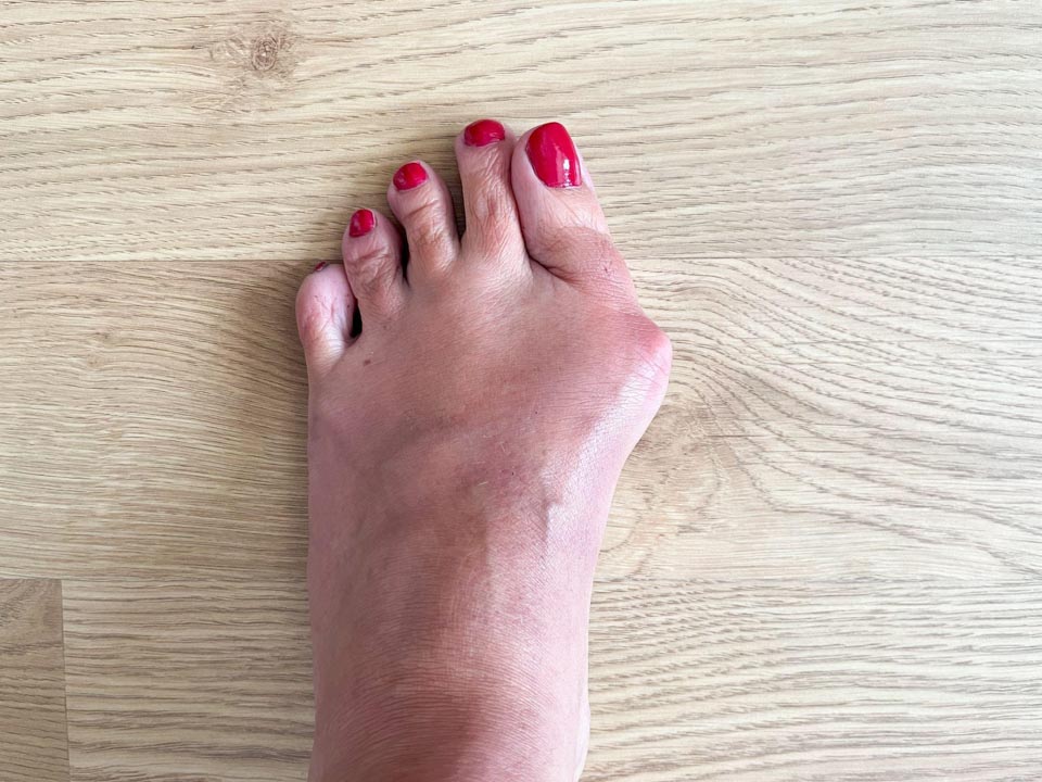 Vbočený palec hallux valgus 1